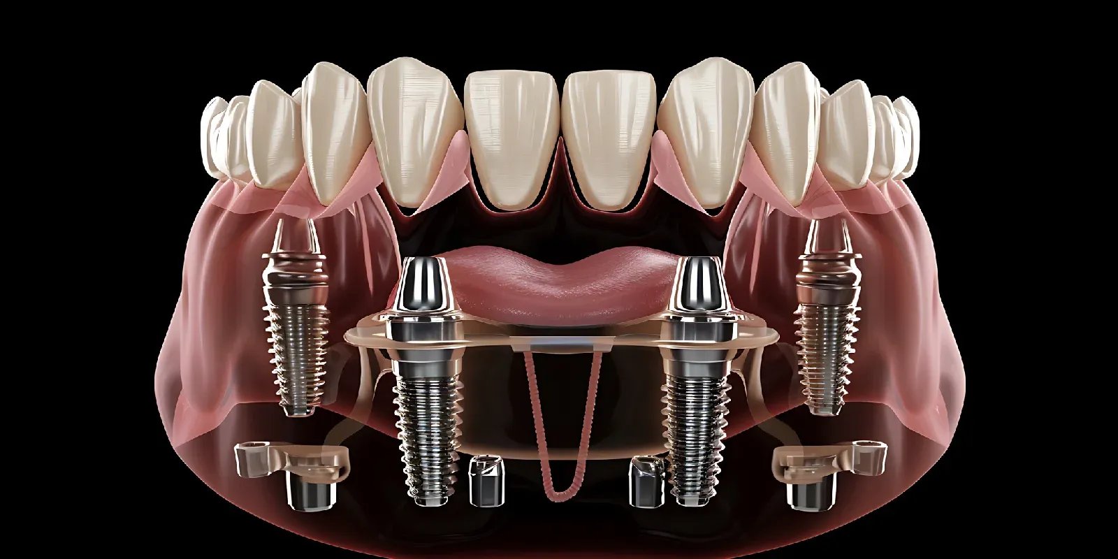 7 Reasons Patients Choose All on 4 Over Traditional Dentures