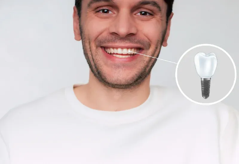 7 Reasons Patients Choose All on 4 Over Traditional Dentures