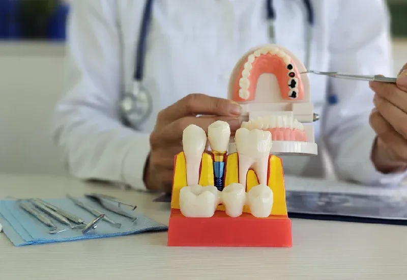 Common Myths About Dental Implants Patients Should Know