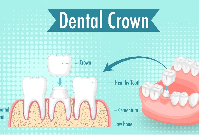 Dental Crowns vs Veneer Which Option Is Right for You-01.webp