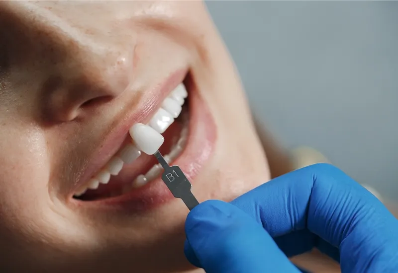 Different Types of Dental Crowns and Their Benefits