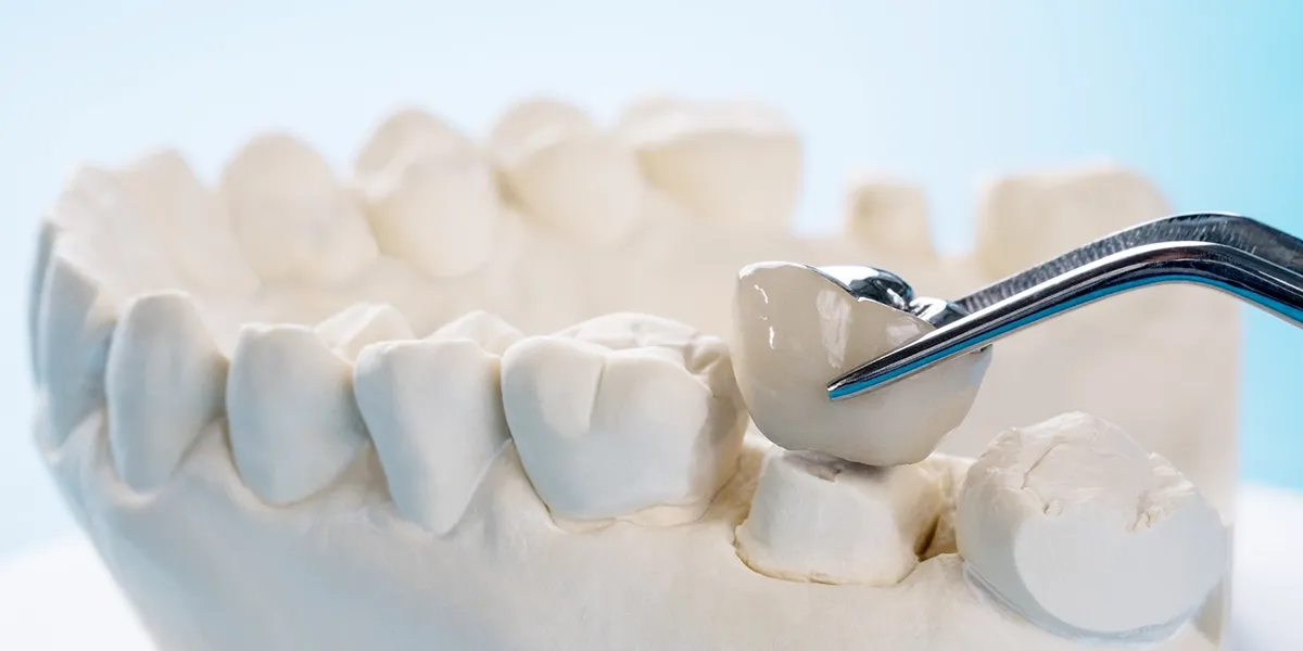 How the Dental Crown Procedure Works Step by Step