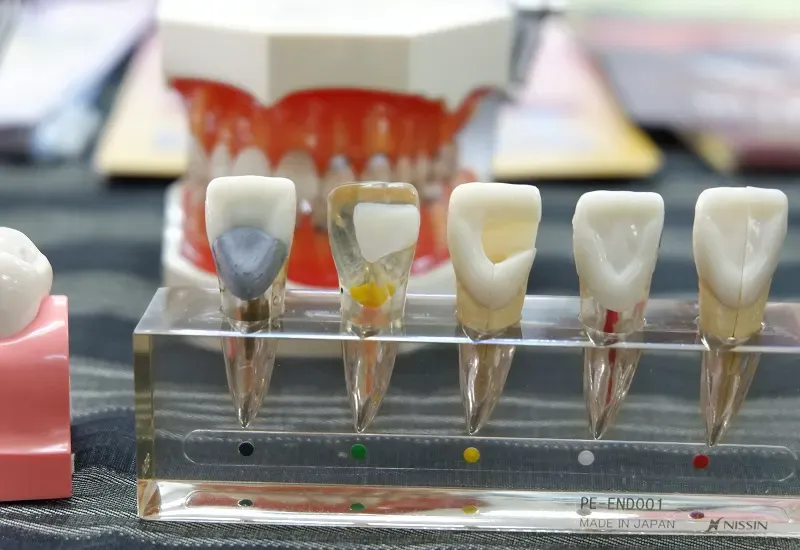 Temporary vs Permanent Crowns: What Patients Should Know