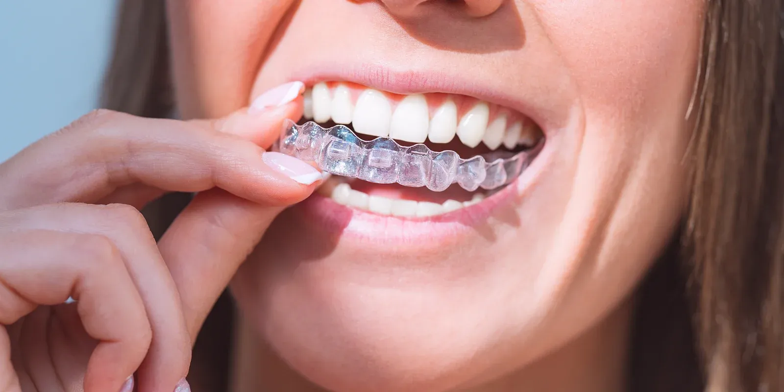 Who Is a Good Candidate for Invisalign? A Dentist’s Evaluation Guide